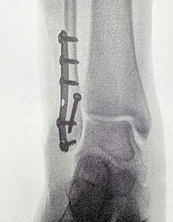 After Surgery