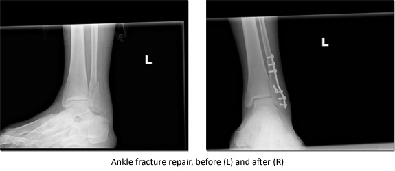 ankle fracture repair