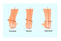 How to Recognize Overpronation