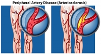 Symptoms and Causes of Peripheral Artery Disease